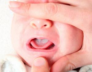 грибок горла у ребенка симптомы лечение