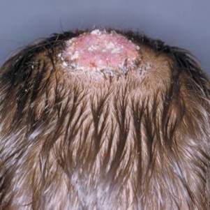грибок кожи головы у ребенка симптомы и лечение