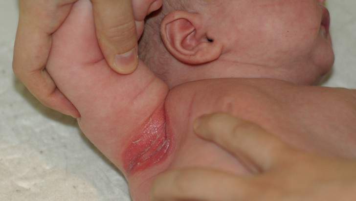 грибы кандида в кишечнике у ребенка симптомы и лечение