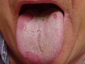 хламидии в горле у ребенка симптомы и лечение