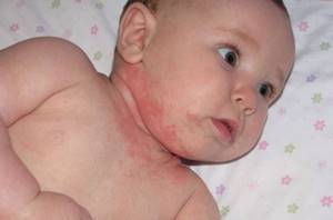 контактный дерматит у ребенка симптомы и лечение