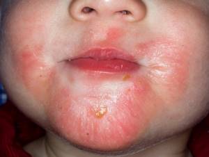 контактный дерматит у ребенка симптомы и лечение