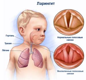 ларингит симптомы и лечение у ребенка 3 года