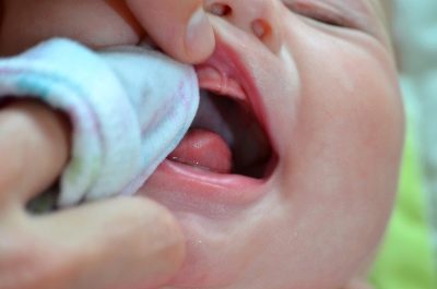 молочница симптомы и лечение молочница у ребенка