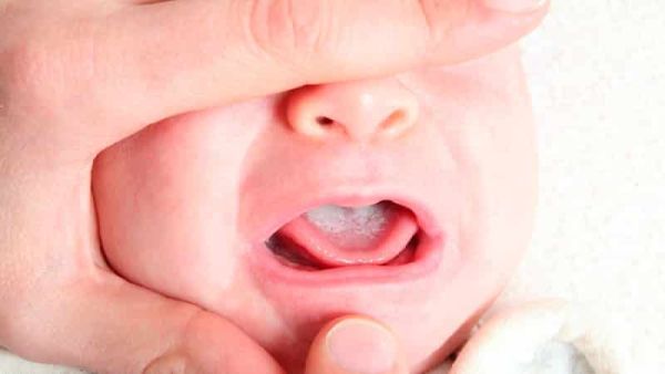молочница симптомы и лечение молочница у ребенка