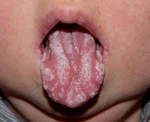 молочница у ребенка после антибиотиков симптомы лечение