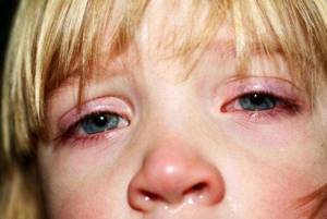 орви у ребенка 4 года симптомы и лечение
