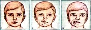 парез лицевого нерва симптомы и лечение у ребенка