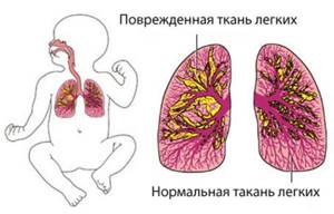 пневмония у ребенка 1 год симптомы и лечение