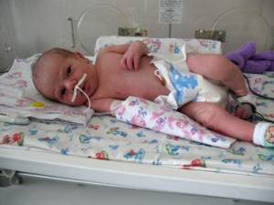 правосторонняя пневмония у ребенка симптомы и лечение