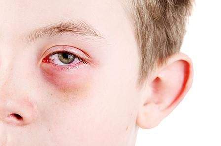 продуло глаз симптомы и лечение у ребенка
