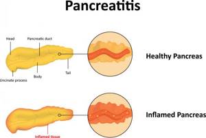 реактивный панкреатит у ребенка 3 года симптомы и лечение