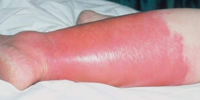 рожистое воспаление ноги симптомы и лечение у ребенка