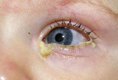 стафилококк у ребенка 2 года симптомы и лечение