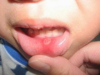 стоматит у ребенка 2 года симптомы и лечение