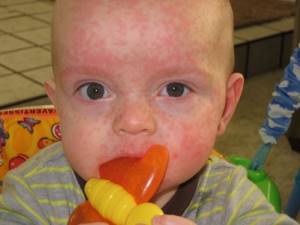 вирус герпеса 6 типа у ребенка симптомы лечение