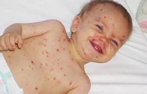 вирус герпеса симптомы и лечение у ребенка