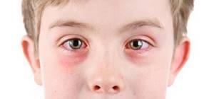 вирусный конъюнктивит симптомы и лечение у ребенка