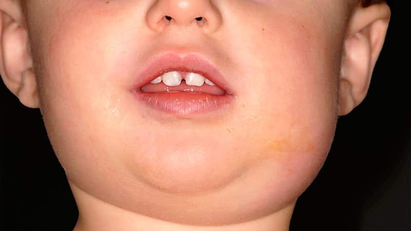 воспаление слюнной железы симптомы лечение у ребенка