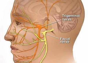 воспаление тройничного нерва у ребенка симптомы и лечение