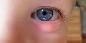 ячмень на глазу у ребенка симптомы и лечение