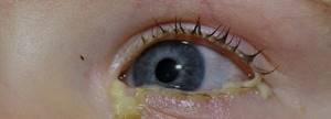 загноение глаз у ребенка симптомы лечение