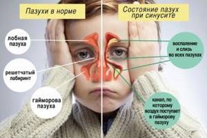золотистый стафилококк в носу у ребенка симптомы лечение