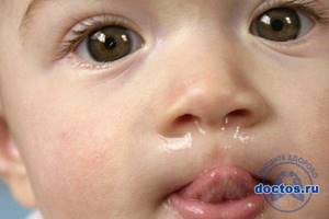 зубные сопли у ребенка симптомы и лечение