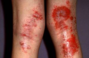 аллергический дерматит симптомы и лечение у взрослых на ногах