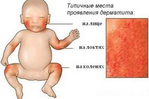 аллергический дерматит симптомы у детей лечение