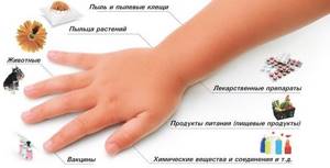 аллергический ларингит симптомы лечение у детей