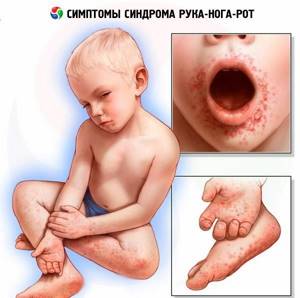 ангина герпетическая лечение симптомы у детей
