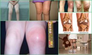 артрит коленного сустава симптомы и лечение у ребенка 10 лет