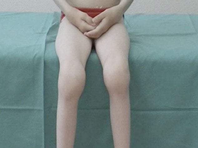 артрит коленного сустава симптомы и лечение у ребенка 5 лет