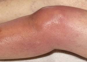 артрит коленного сустава симптомы и лечение у ребенка 5 лет