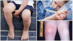 артрит коленного сустава симптомы и лечение у ребенка 9 лет