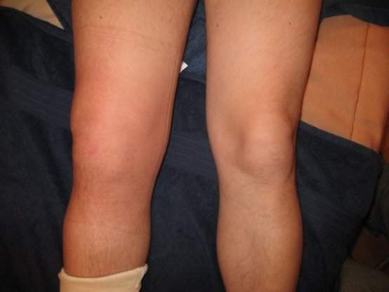 артрит коленного сустава симптомы и лечение у ребенка 9 лет