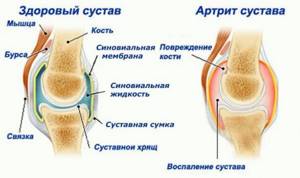 артрит коленного сустава у ребенка 4 лет симптомы и лечение