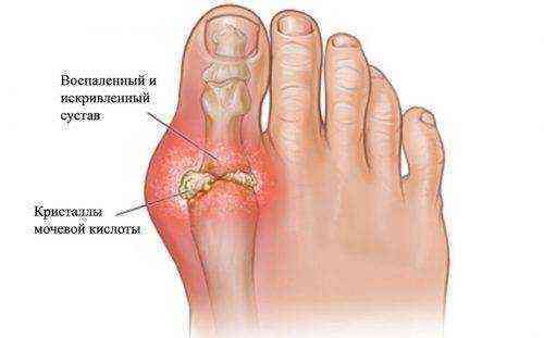 артрит пальца ноги симптомы и лечение