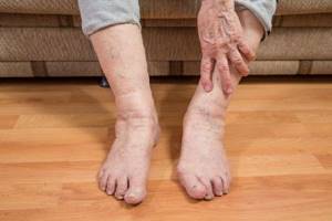 артрит симптомы лечение ноги