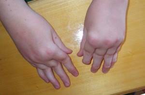 артрит у детей симптомы причины лечение