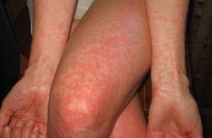 атопический дерматит у детей на ногах симптомы и лечение