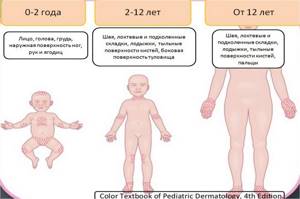 атопический дерматит у детей симптомы лечение
