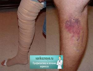 боль в ногах при варикозе симптомы лечение
