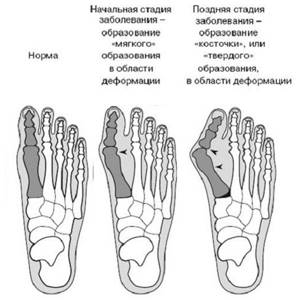 бурсит большого пальца ноги симптомы и лечение
