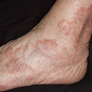 дерматит симптомы и лечение у взрослых на ногах