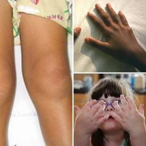детский ревматоидный артрит симптомы лечение