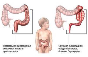 долихосигма симптомы у детей и лечение