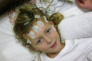 эпилепсия у детей симптомы и лечение