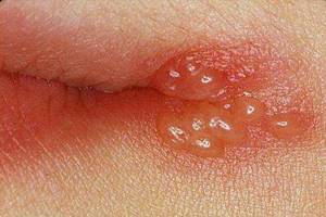 герпес на губах у ребенка 3 года симптомы и лечение
